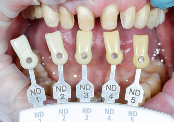 Anterior tooth preparation for dental crown build-up. Scale for determining the color of the cast...