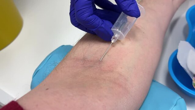 Nurse draws venous blood from a man's median cubital vein for analysis or donation in a clinic or hospital. Close up