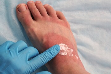 A doctor in blue gloves makes cream treatment on redness woman's leg as result of skin burn. Foot soreness after sunburn. Dermatology problems. Inflammation sensitive skin from allergies. Thermal burn