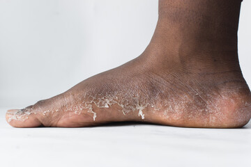 Process of foot peeling, brown skin foot in the prcesss of peeling, skin shedding on a foot