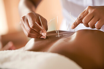 Woman in an acupuncture therapy - obrazy, fototapety, plakaty