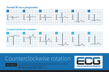 Generally, in chest leads, the R/S amplitude ratio =1 appears in lead V3-V4. Once it appears in lead V1-V3, it is counterclockwise transposition, which is a common ECG phenomenon.