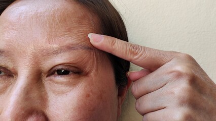 Portrait showing the fingers holding the flabbiness and wrinkle beside the eyelid, dark spots and blemish on the face, freckles complexion of the woman, health care and beauty concept.