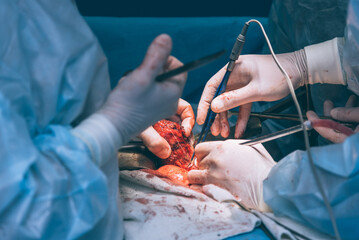 A highly qualified team of surgeons performs a complex operation to remove a pancreatic cyst using...