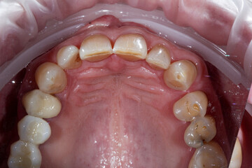 Obraz premium Dentistry. Human open mouth with dental decay