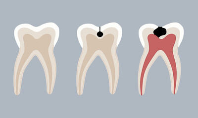 Human teeth. Healthy and with caries. The tooth is incised.