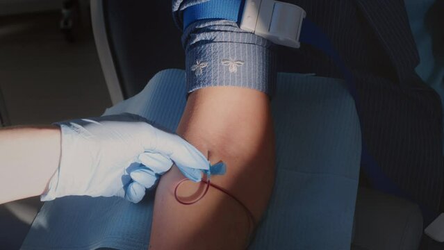 Close-up of the blood collection. A woman's hand, blood moving through the tube. A female doctor's hand in rubber gloves. A needle is inserted into the patient's vein. Blood test, check-up of the body