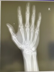 x ray of hand
