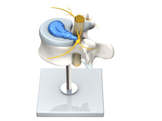 Model of a herniated disc of the lumbar spine, stenosis, slipped disc. 3D Illustration