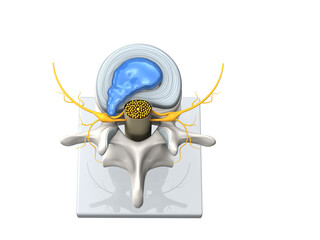 Model of a herniated disc of the lumbar spine, stenosis, slipped disc. 3D Illustration