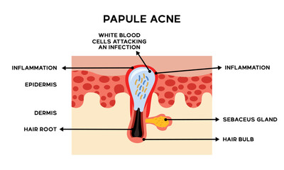 Illustration of the anatomy of papule acne skin along with an explanation of the names of each part
