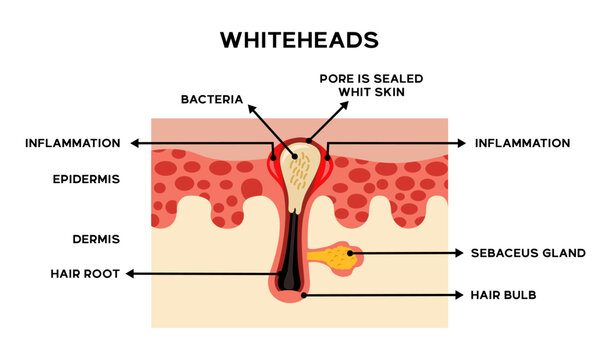 Illustration of the anatomy of whitehead skin along with an explanation of the names of each part