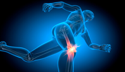 Running man with pain in knee joint - 3D illustration - obrazy, fototapety, plakaty