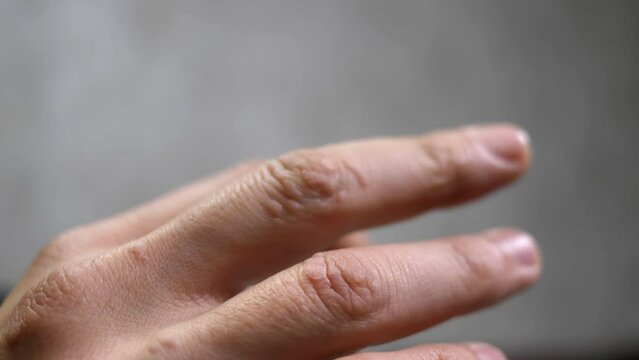 Close-up of a hand with many warts on the skin of a person's fingers. Concept of skin diseases and papilloma virus. HPV