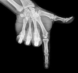 Film xray x-ray or radiograph of a thumb and finger in gestural language, manual communication, or signing aka sign language, pointing this way or that way down or downward downstairs