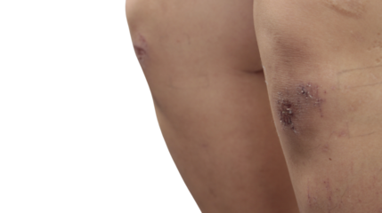 Knees and Legs with Fresh Wounds, Injuries from Blows or Falls, on Isolated Background.