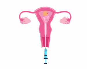 Infertility treatment using Artificial fertilization Human Reproductive technology vector illustration.