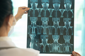 Orthopedic surgeons or Orthopedic surgery doctor check x-ray images of Cervical spondylosis for...