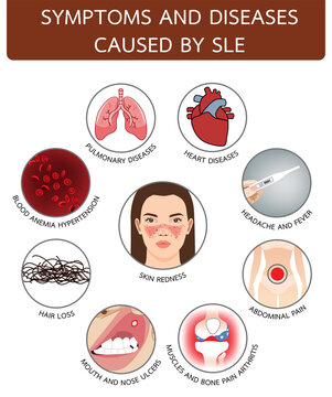 Symptoms and diseases caused by SLE, infographic illustration on white background