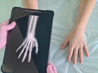 Doctor holding tablet with x-ray of child patient hand