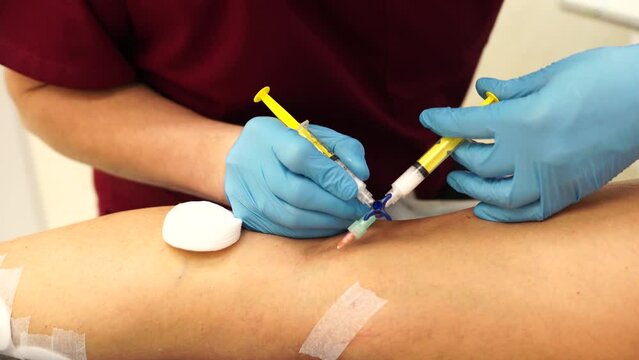 Removal of varicose veins on the legs. Doctor doing sclerotherapy