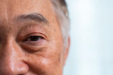 Close up of the senile cataract during eye examination. A white cloudy disc is seen in black eye circle, mature cataract, nuclear sclerosis cataract. Close up half face view