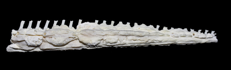 Hypertrophic osteoarthropathy (HOA)