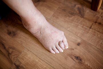 A detailed shot of the foot of an older woman, highlighting age-related conditions such as nail and...