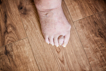 Foot  close up of an elderly woman with age-related conditions.Nail and skin disease, vascular...