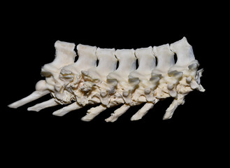 Osteoarthritis, a degenerative joint disease