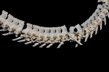 Osteoarthritis, a degenerative joint disease