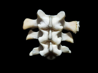 Osteoarthritis, a degenerative joint disease