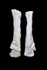 Periostitis, inflammation of the periosteum