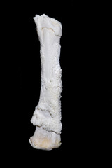 Periostitis, inflammation of the periosteum