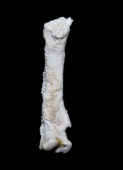 Periostitis, inflammation of the periosteum