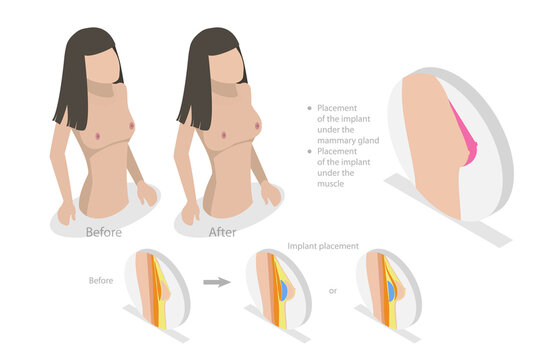 3D Isometric Flat  Conceptual Illustration of Breast Implant, Bust Enhancement Operation
