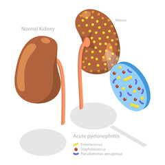 3D Isometric Flat  Conceptual Illustration of Acute Pyelonephritis, Urinary Tract Infection