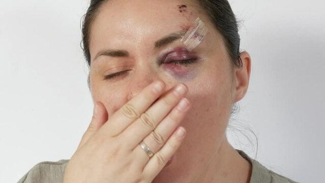 Young woman yawns at the camera with real bruise hematoma under eye of a young woman, fresh purple bruise and scratches on forehead from a blow. terrified face of domestic violence victim