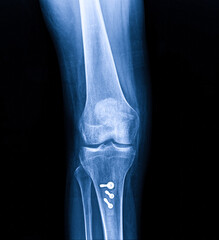 X-ray Knee Joint Fracture proximal tibia and Post fix fracture proximal tibia with plate and...