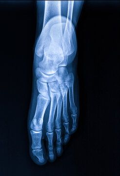 X-rays of the human foot