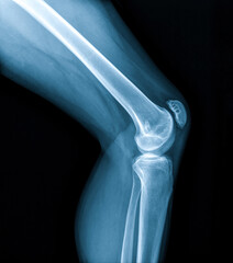 Knee joint x-ray (AP and LATERAL) view fracture and displacement of the patella bone or knee cap