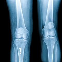 X-ray Knee Joint Fracture proximal tibia and Post fix fracture proximal tibia with plate and screws.Normal joint space.Minimal joint effusion