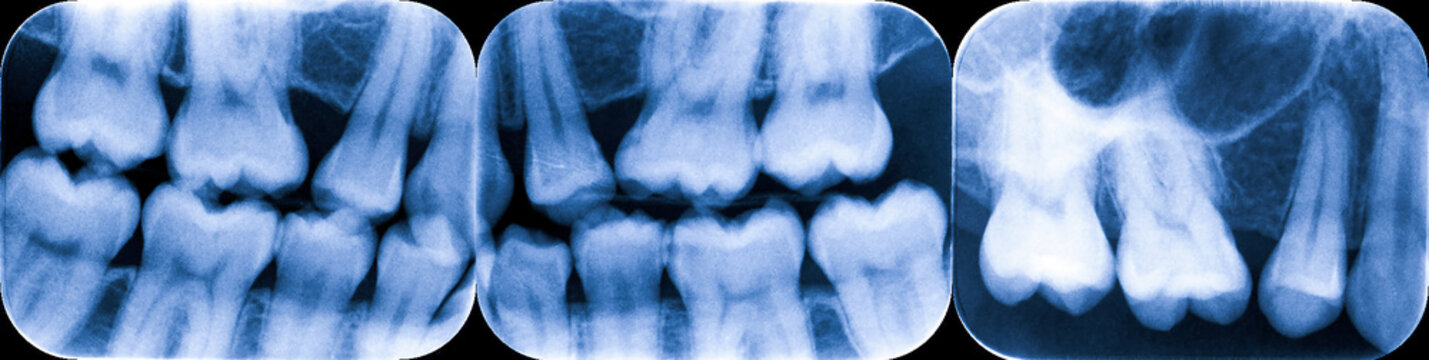 x-ray of teeth