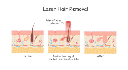 Laser hair removal of the skin layer against hair. Medical diagram before and after using laser hair removal. - obrazy, fototapety, plakaty