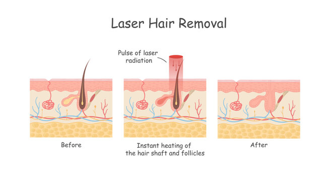 Laser hair removal of the skin layer against hair. Medical diagram before and after using laser hair removal.