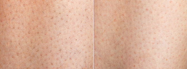 Collage before and after hair removal. Image before and after leg hairs removal concept. close up