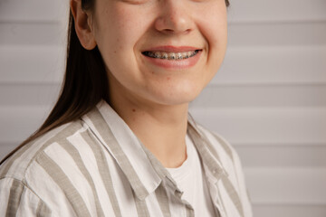 unrecognizable happy woman with braces indoors in clinic or at home. close up view