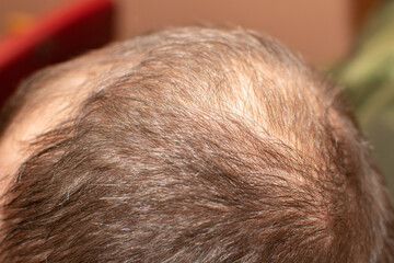 A close up view of the top of a head of a balding man	