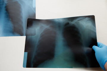 A hand in a blue medical glove holding a chest X-ray on a white background, and another X-ray. Lung...