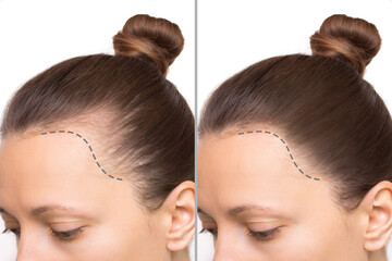 Cropped before and after head shot of a young woman with bald patches on her forehead and temples. Baldness. Close-up, side view. Hair care and treatment concept. Hair loss, hair extensions, alopecia - obrazy, fototapety, plakaty